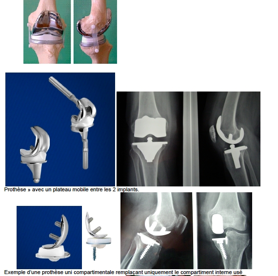 Arthrose et Prothèses de genou – Chirurgie Orthopédique & Sportive
