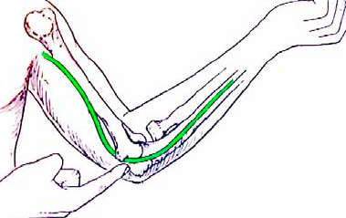 Compression nerf cubital au coude Alès